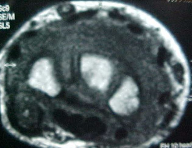 Figure 4 for case Psoriatic arthritis on the wrist